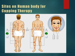 Sites on Human body for
Cupping Therapy
 