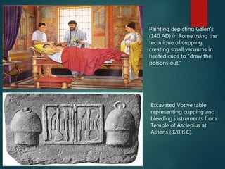 Excavated Votive table
representing cupping and
bleeding instruments from
Temple of Asclepius at
Athens (320 B.C).
Painting depicting Galen's
(140 AD) in Rome using the
technique of cupping,
creating small vacuums in
heated cups to "draw the
poisons out."
 