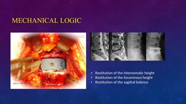 Anterior Lumbar Approach Lumbar Disc Prosthesis Leflot J L Ppt