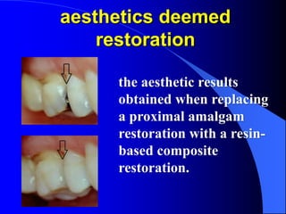 aesthetics deemed
restoration
the aesthetic results
obtained when replacing
a proximal amalgam
restoration with a resin-
b...