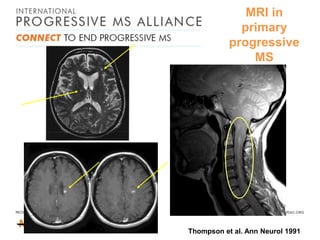 MRI in
primary
progressive
MS

Thompson et al. Ann Neurol 1991

 