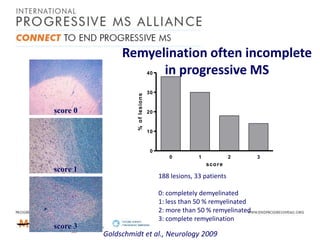 Remyelination often incomplete
in progressive MS
score 0

% o f lesio n s

40

30

20

10

0
0

score 1

1

2

sco r e

188 lesions, 33 patients
0: completely demyelinated
1: less than 50 % remyelinated
2: more than 50 % remyelinated
3: complete remyelination

score 3

Goldschmidt et al., Neurology 2009

3

 