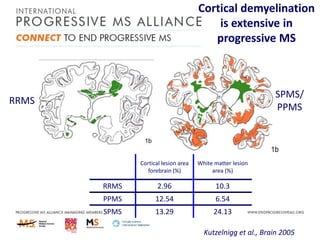Cortical demyelination
is extensive in
progressive MS

SPMS/
PPMS

RRMS

Cortical lesion area
forebrain (%)

White matter lesion
area (%)

RRMS

2.96

10.3

PPMS

12.54

6.54

SPMS

13.29

24.13
Kutzelnigg et al., Brain 2005

 