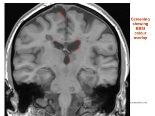 Screening
showing
BBSI
colour
overlay

 