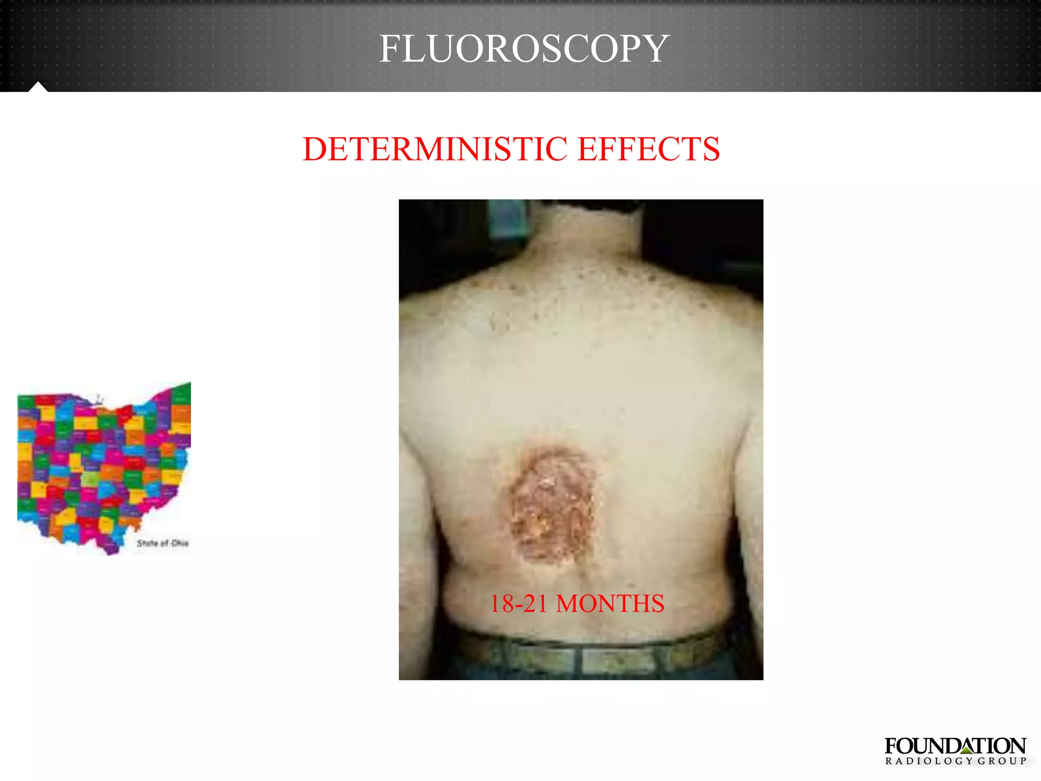 FLUOROSCOPY

DETERMINISTIC EFFECTS




         18-21 MONTHS
 