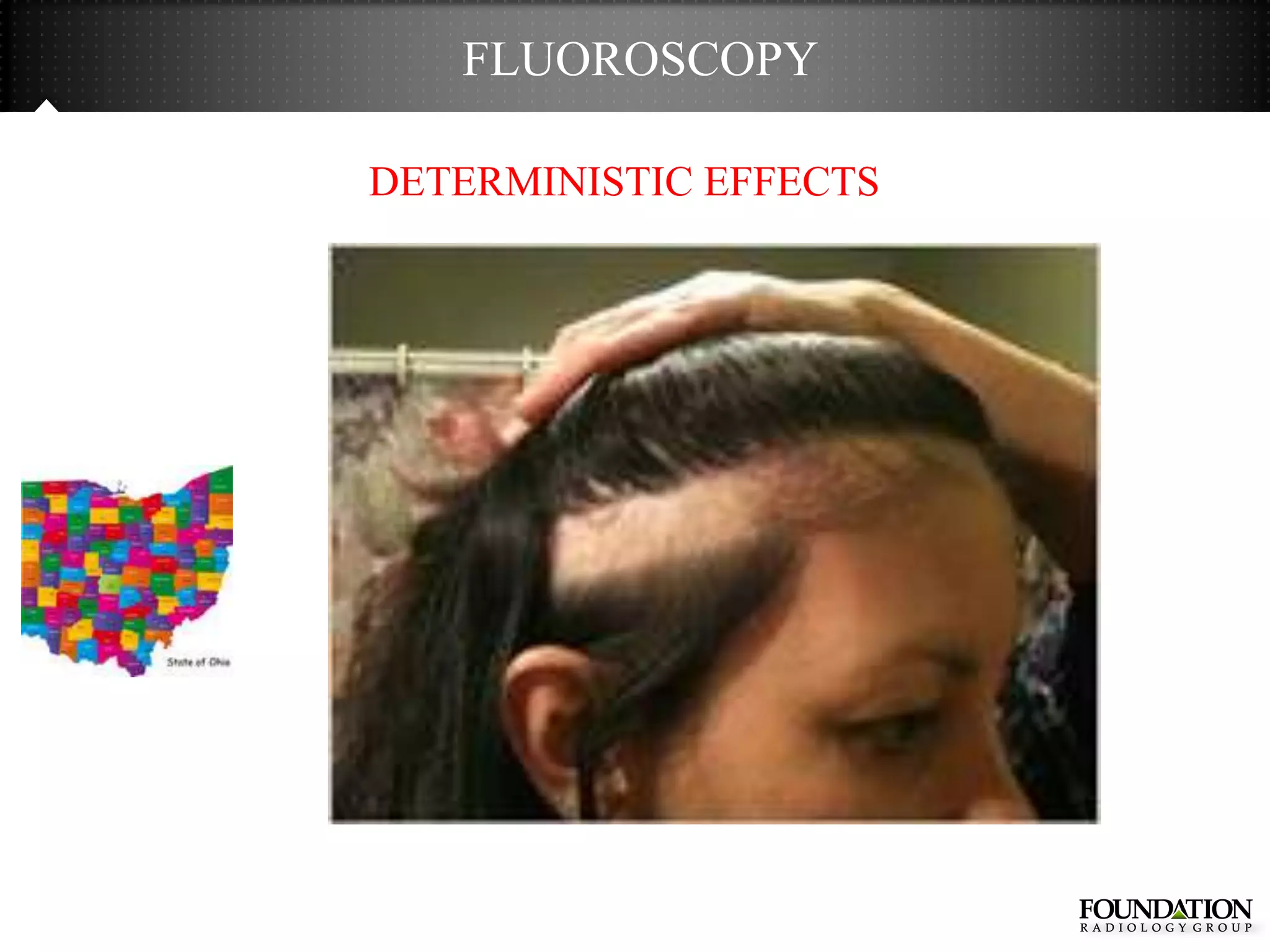 FLUOROSCOPY

DETERMINISTIC EFFECTS
 