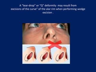 Alar base surgery | PPTX