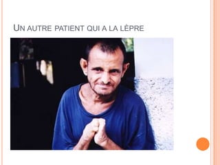 UN AUTRE PATIENT QUI A LA LÈPRE
 
