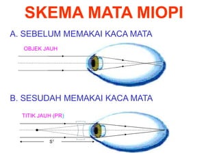 SKEMA MATA MIOPI
A. SEBELUM MEMAKAI KACA MATA
B. SESUDAH MEMAKAI KACA MATA
OBJEK JAUH
TITIK JAUH (PR)
S1
 