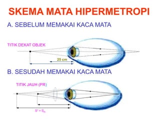 SKEMA MATA HIPERMETROPI
A. SEBELUM MEMAKAI KACA MATA
B. SESUDAH MEMAKAI KACA MATA
TITIK DEKAT OBJEK
TITIK JAUH (PR)
S1 = Sn
25 cm
 