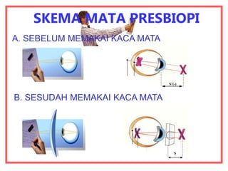 SKEMA MATA PRESBIOPI
S
S’(-)
A. SEBELUM MEMAKAI KACA MATA
B. SESUDAH MEMAKAI KACA MATA
 