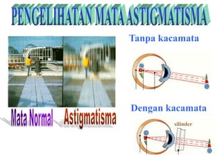 Tanpa kacamata
Dengan kacamata
silinder
 