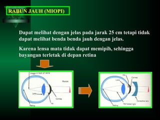 RABUN JAUH (MIOPI)

Dapat melihat dengan jelas pada jarak 25 cm tetapi tidak
dapat melihat benda benda jauh dengan jelas.
Karena lensa mata tidak dapat memipih, sehingga
bayangan terletak di depan retina

 