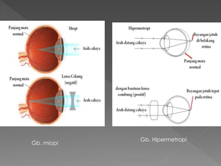 Gb. miopi
Gb. Hipermetropi
 