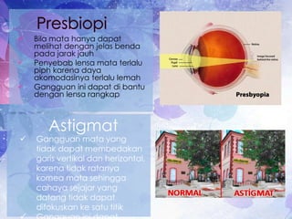  Bila mata hanya dapat
melihat dengan jelas benda
pada jarak jauh
 Penyebab lensa mata terlalu
piph karena daya
akomodasinya terlalu lemah
 Gangguan ini dapat di bantu
dengan lensa rangkap
 Gangguan mata yang
tidak dapat membedakan
garis vertikal dan herizontal,
karena tidak ratanya
kornea mata sehingga
cahaya sejajar yang
datang tidak dapat
difokuskan ke satu titik
Astigmat
 