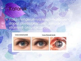  Yaitu mengeruhnya lensa mata, yang
dapat disebabkan oleh kekurangan
vitamin B atau faktor usia
 