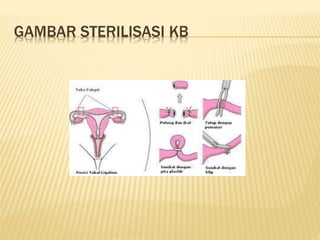 GAMBAR STERILISASI KB
 