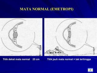 MATA NORMAL (EMETROPI)Titik dekat mata normal ± 25 cmTitik jauh mata normal = tak terhingga4