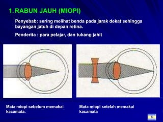 RABUN JAUH (MIOPI)Penyebab: sering melihat benda pada jarak dekat sehingga bayangan jatuh di depan retina.Penderita : para pelajar, dan tukang jahitMata miopi sebelum memakai kacamata.Mata miopi setelah memakai kacamata6