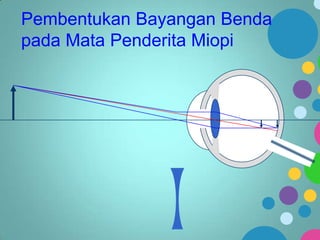 Pembentukan Bayangan Benda
pada Mata Penderita Miopi

 