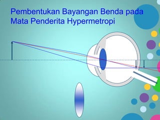 Pembentukan Bayangan Benda pada
Mata Penderita Hypermetropi

 