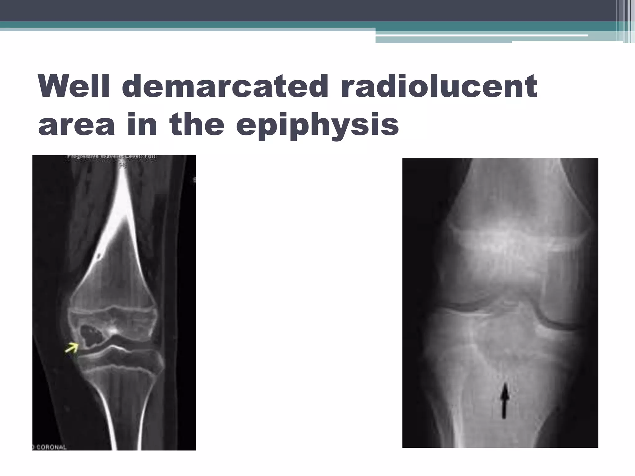 Well demarcated radiolucent
area in the epiphysis
 