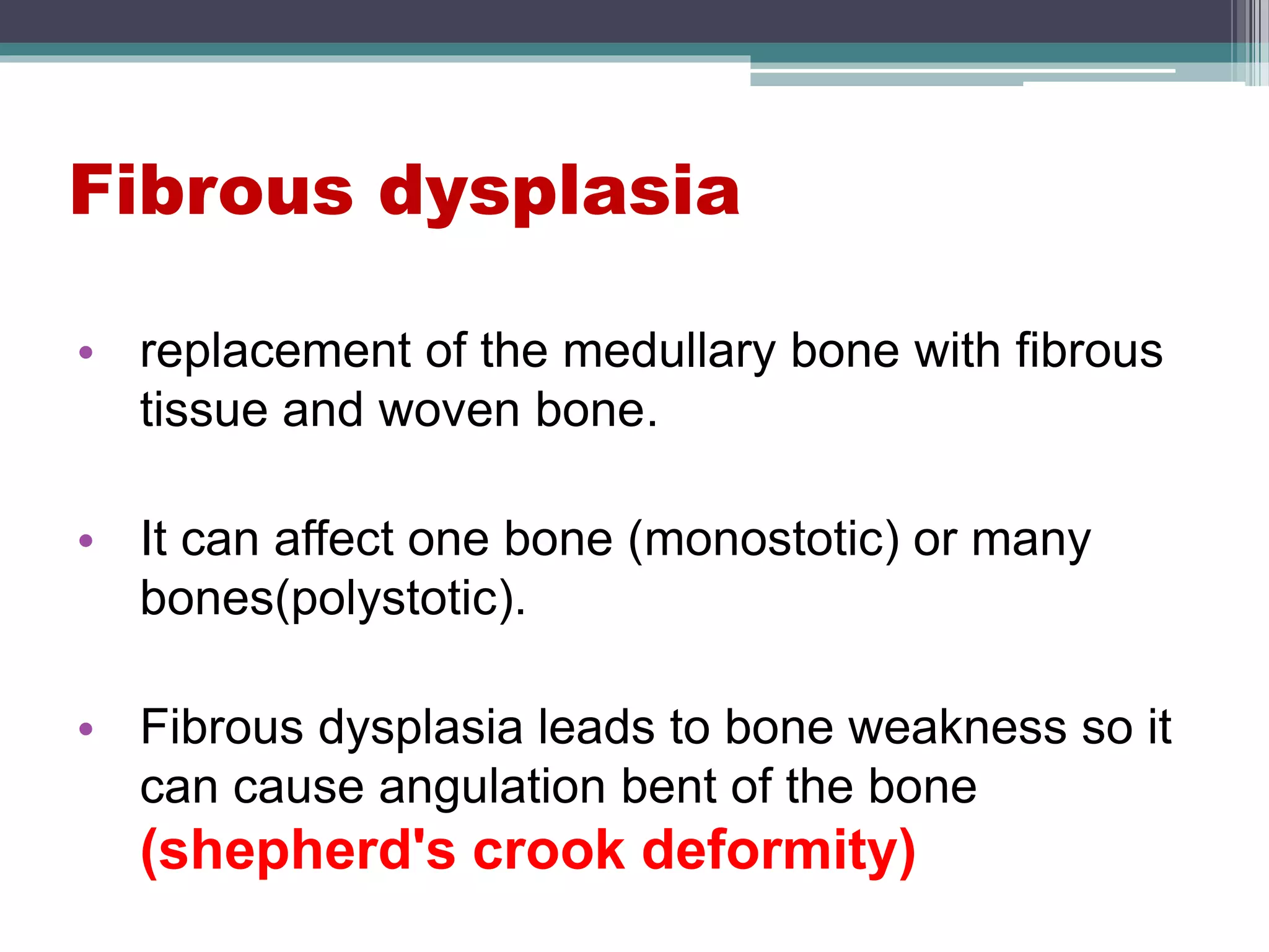 Fibrous dysplasia
• replacement of the medullary bone with fibrous
tissue and woven bone.
• It can affect one bone (monostotic) or many
bones(polystotic).
• Fibrous dysplasia leads to bone weakness so it
can cause angulation bent of the bone
(shepherd's crook deformity)
 