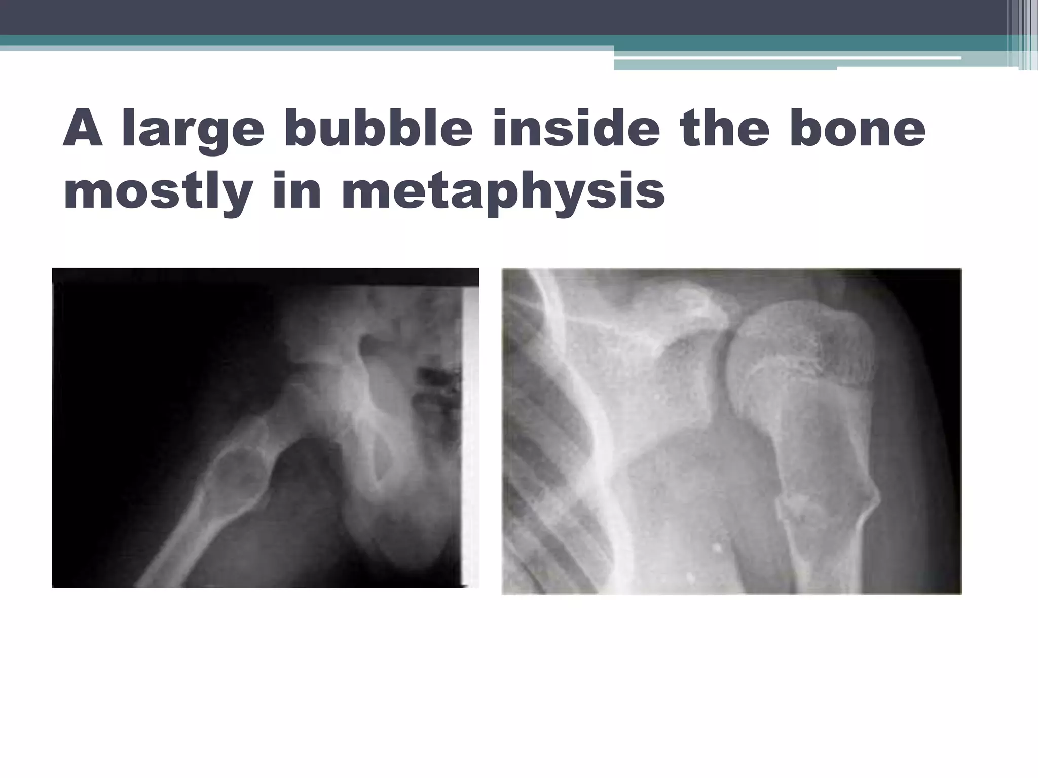 A large bubble inside the bone
mostly in metaphysis
 
