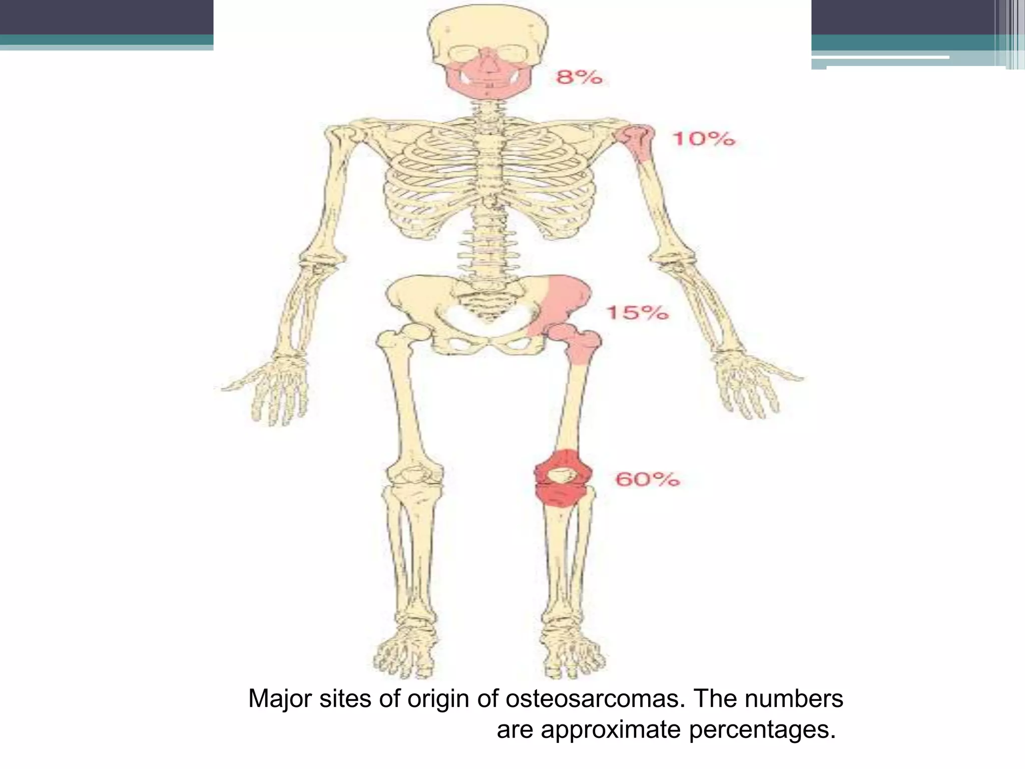 Major sites of origin of osteosarcomas. The numbers
are approximate percentages.
 