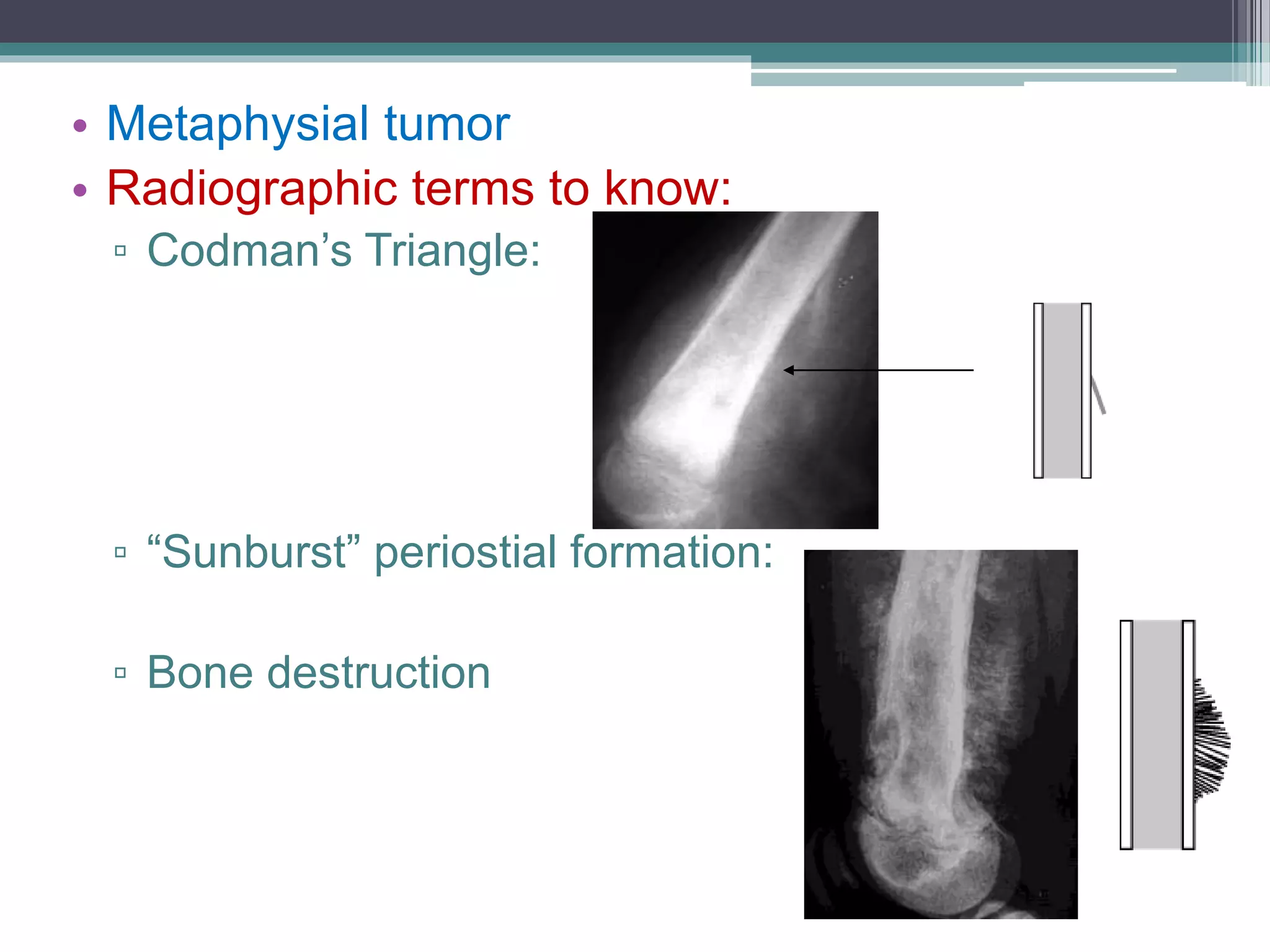 • Metaphysial tumor
• Radiographic terms to know:
▫ Codman’s Triangle:
▫ “Sunburst” periostial formation:
▫ Bone destruction
 