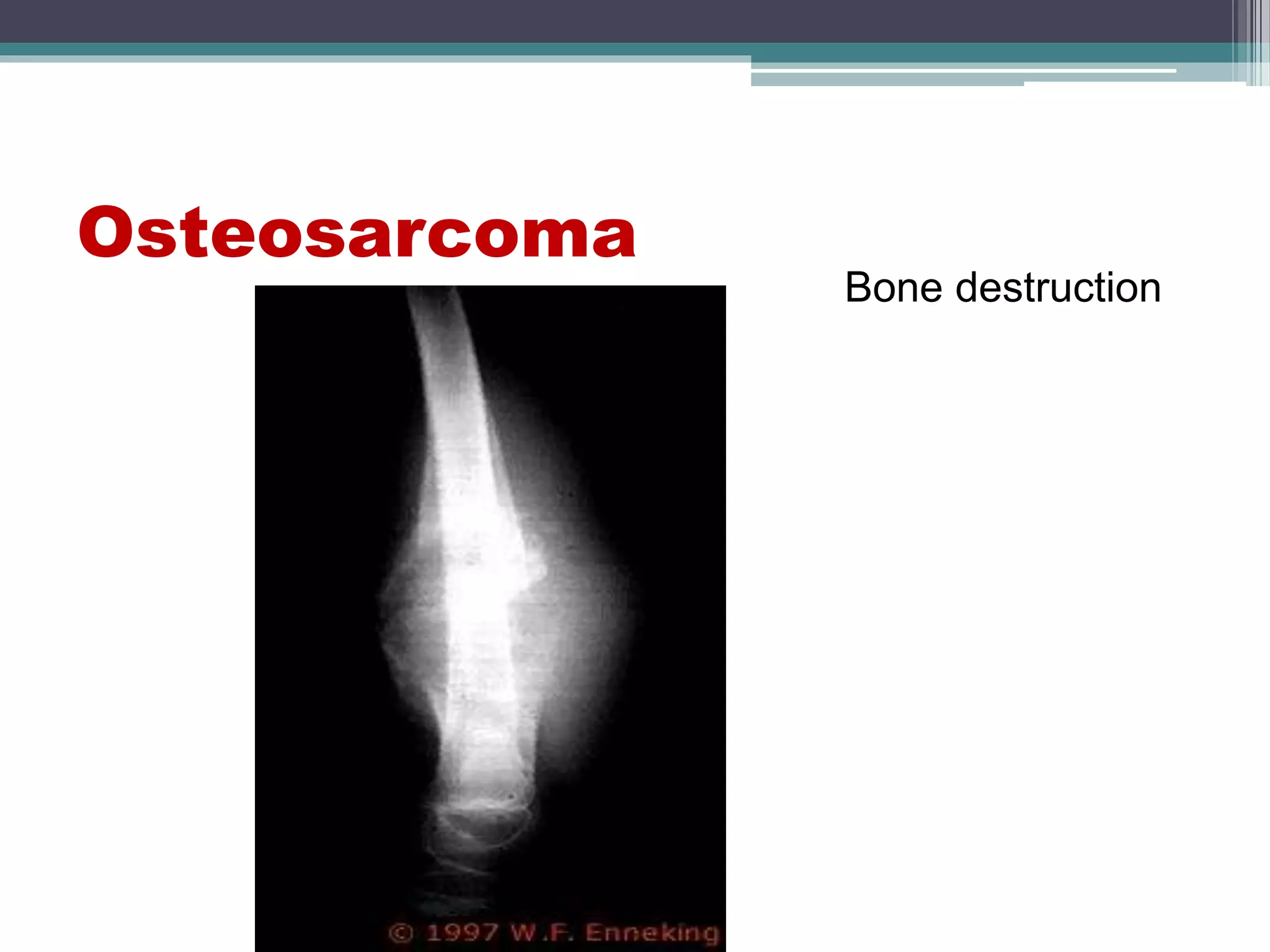 Osteosarcoma
Bone destruction
 