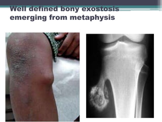 Exostis Bone Tumor (Benign and malignant) | PPTX