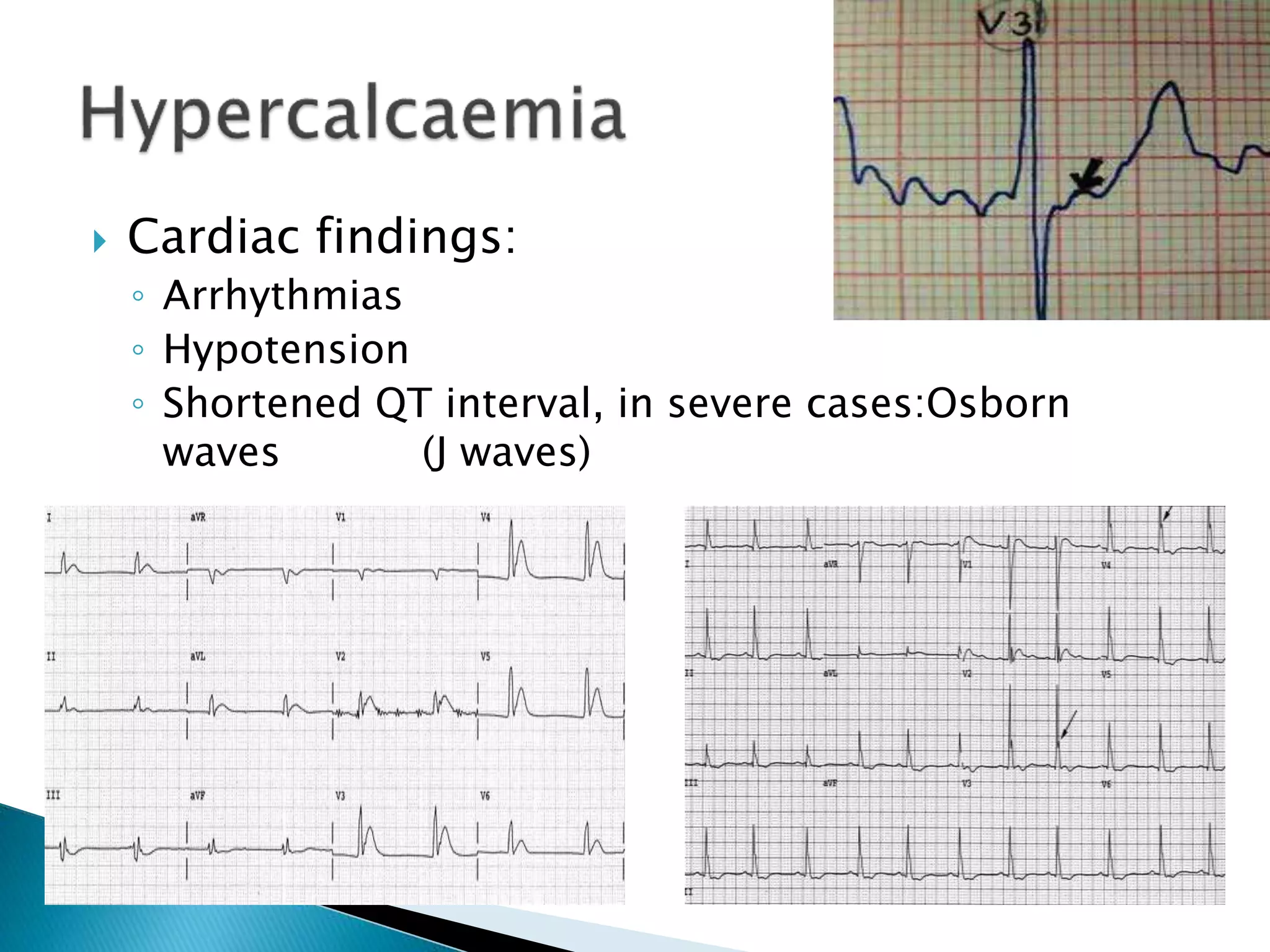  Cardiac findings:
◦ Arrhythmias
◦ Hypotension
◦ Shortened QT interval, in severe cases:Osborn
waves (J waves)
 