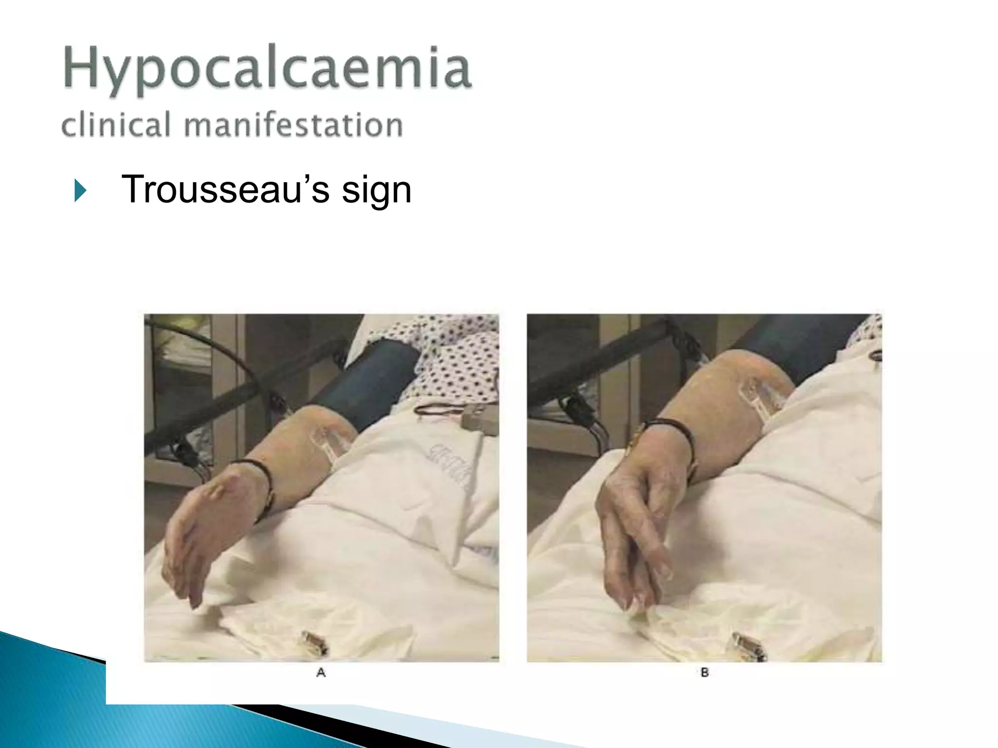  Trousseau’s sign
ousseau’s signs
 