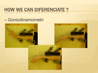HOW WE CAN DIFERENCIATE ?
 Goniodinamometri
 