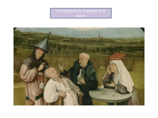 La extracción de la piedra de la
locura
 