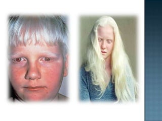 Albinism