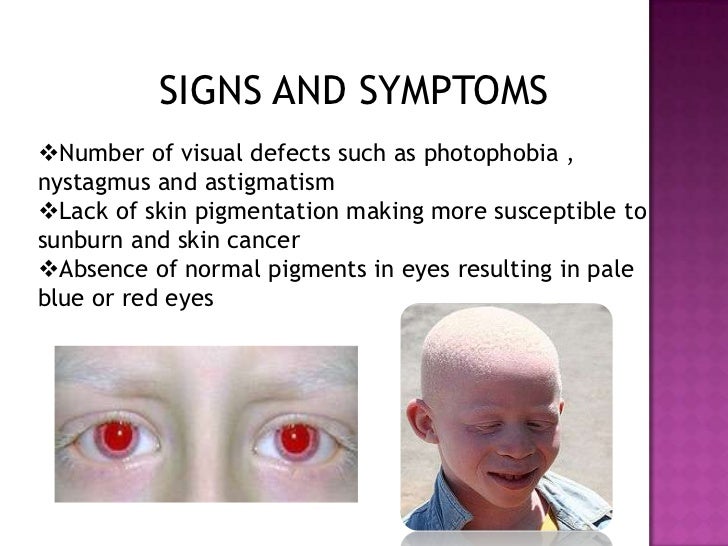 Albinism