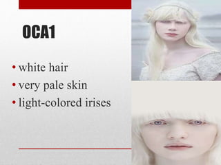 OCA1
• white hair
• very pale skin
• light-colored irises
 