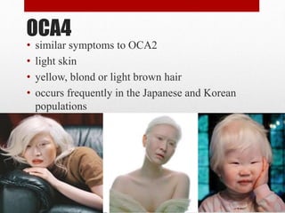 OCA4
• similar symptoms to OCA2
• light skin
• yellow, blond or light brown hair
• occurs frequently in the Japanese and Korean
populations
 