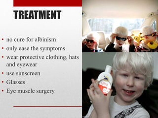 TREATMENT
• no cure for albinism
• only ease the symptoms
• wear protective clothing, hats
and eyewear
• use sunscreen
• Glasses
• Eye muscle surgery
 