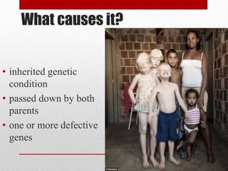 What causes it?
• inherited genetic
condition
• passed down by both
parents
• one or more defective
genes
 