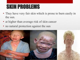 • They have very fair skin which is prone to burn easily in
the sun.
• at higher than average risk of skin cancer
• no natural protection against the sun
SKIN PROBLEMS
 