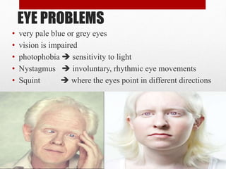 EYE PROBLEMS
• very pale blue or grey eyes
• vision is impaired
• photophobia  sensitivity to light
• Nystagmus  involuntary, rhythmic eye movements
• Squint  where the eyes point in different directions
 