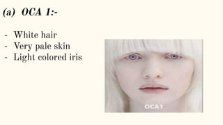 (a) OCA 1:-
- White hair
- Very pale skin
- Light colored iris
 