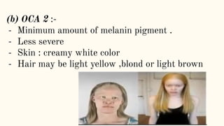 (b) OCA 2 :-
- Minimum amount of melanin pigment .
- Less severe
- Skin : creamy white color
- Hair may be light yellow ,blond or light brown
 