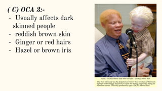 ( C) OCA 3:-
- Usually affects dark
skinned people
- reddish brown skin
- Ginger or red hairs
- Hazel or brown iris
 