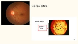 Normal retina
 