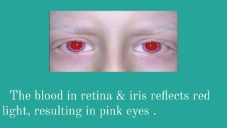 The blood in retina & iris reﬂects red
light, resulting in pink eyes .
 