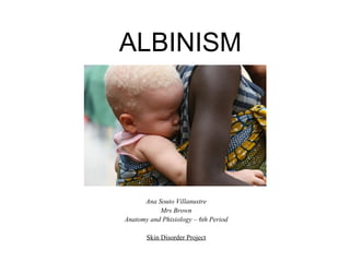 ALBINISM




      Ana Souto Villanustre
           Mrs Brown
Anatomy and Phisiology – 6th Period

       Skin Disorder Project
 